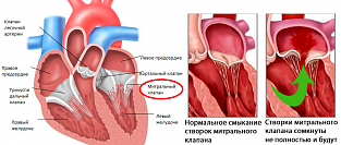 Митральная регургитация (митральная недостаточность). Информация для пациентов.